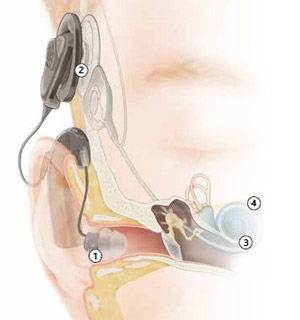 cochlearimplant-traditional-aid
